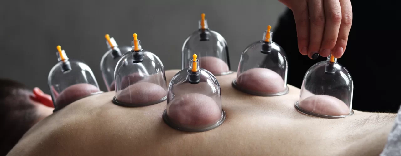 cupping Therapy